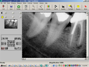 dental x-ray on screen