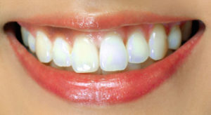 closeup of white smile