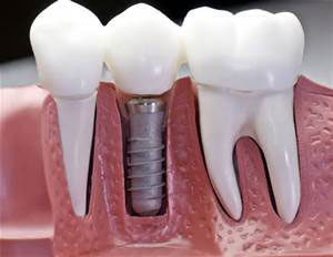 tooth implant